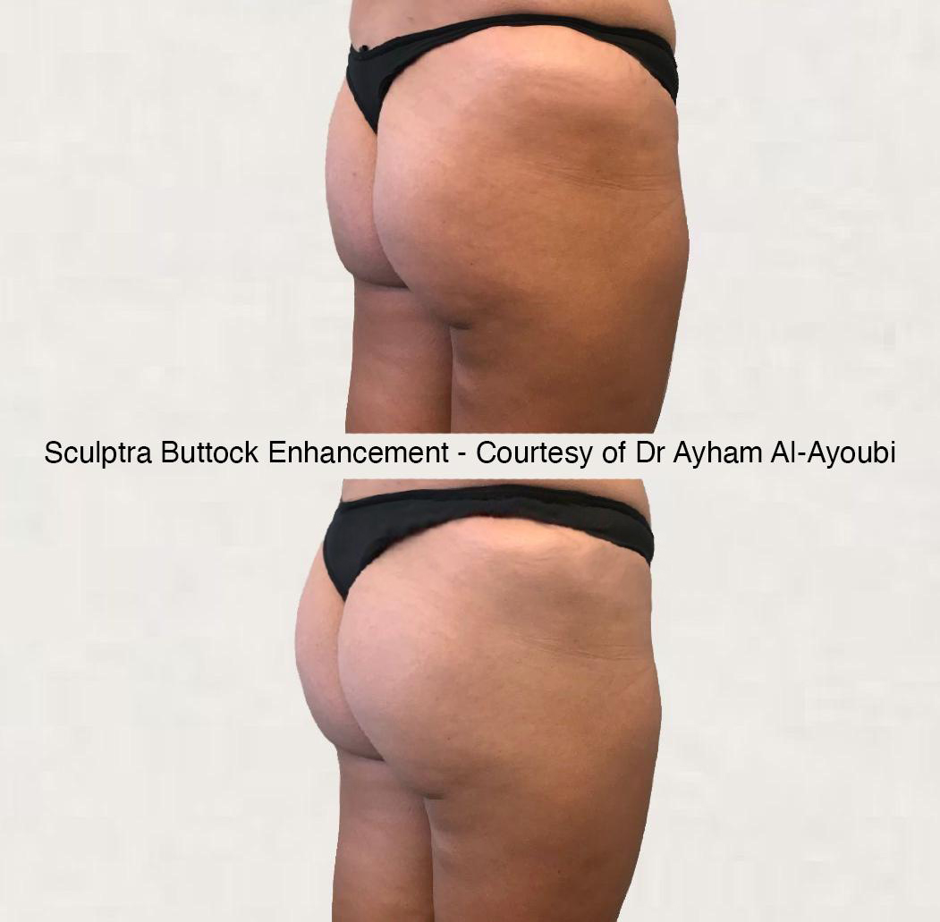 Sculptra® Butt Lift (BBL)  Omaha Cosmetic Surgery - Imagen