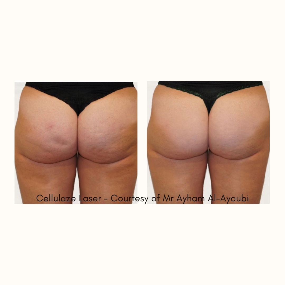 Anti-Cellulite Treatment – Doctor Led Aesthetic Clinic – London Beauty  Clinic